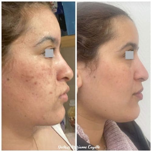 Taches acné peau pigmentée traitement avant après · Dr Marianne Cayatte Montpellier